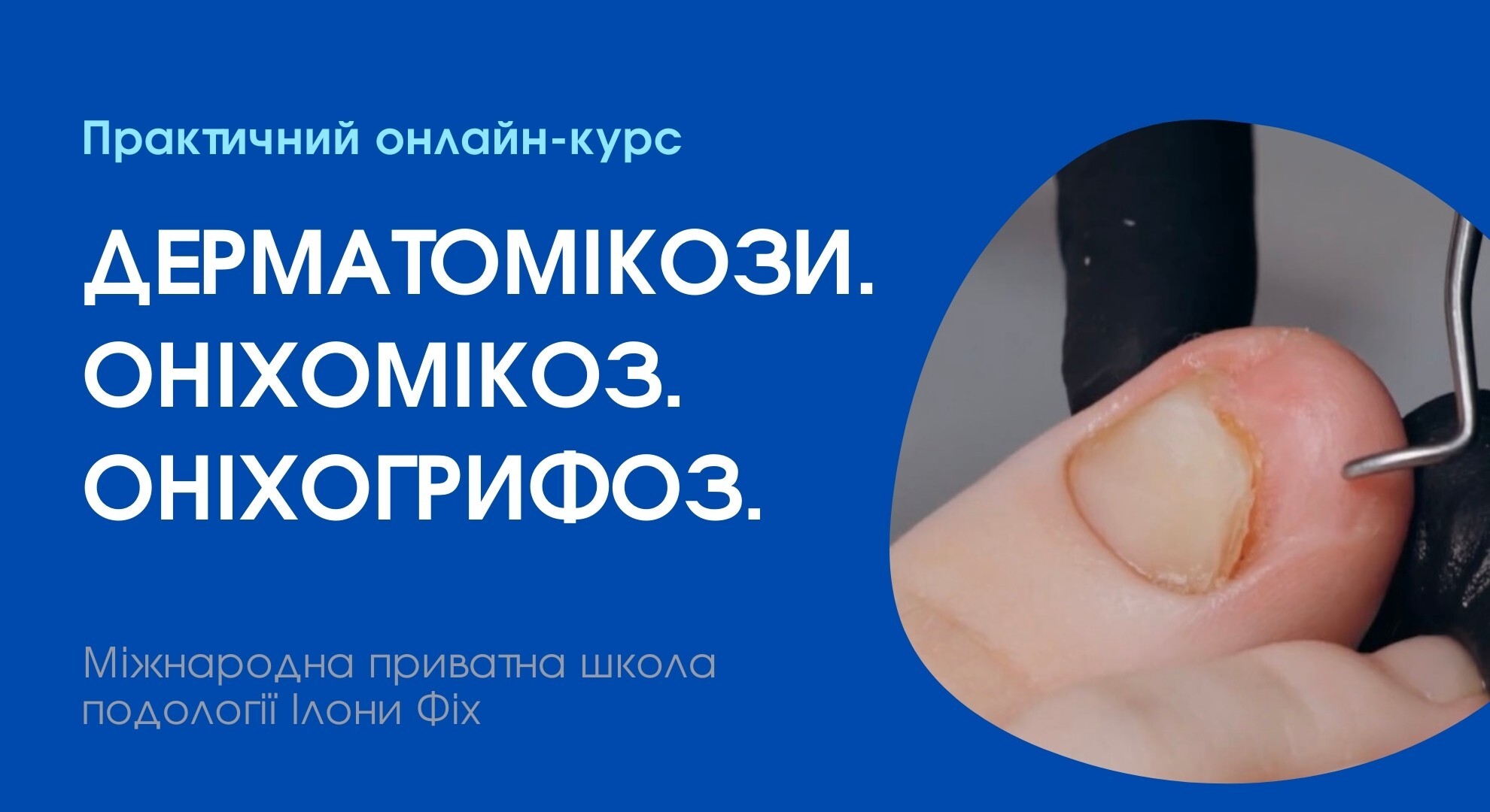 КУРС 'ДЕРМАТОМІКОЗИ. ОНІХОМІКОЗ. ОНІХОГРИФОЗ.'