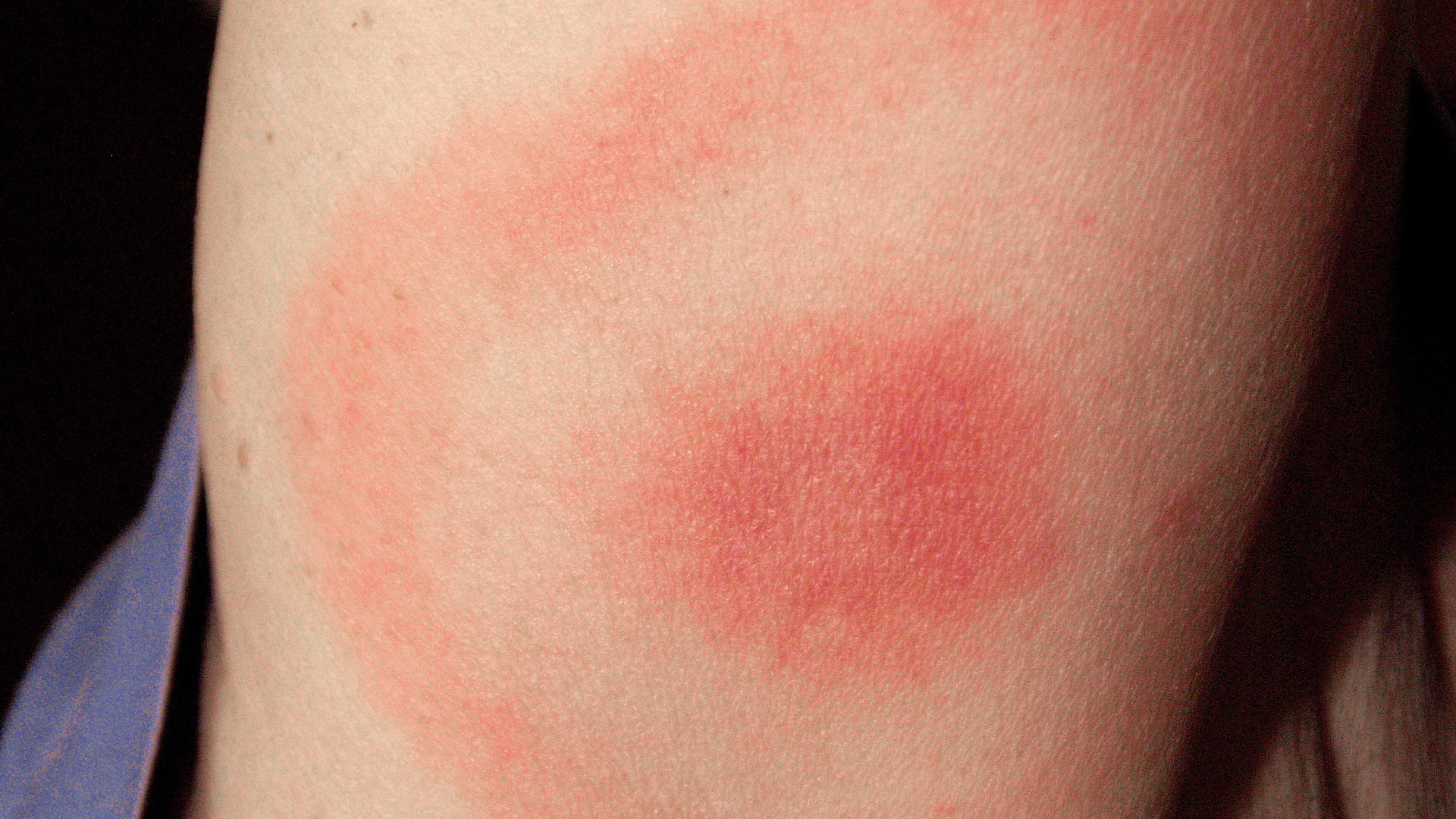 «Все про Лайм-бореліоз» Н. Прийменко