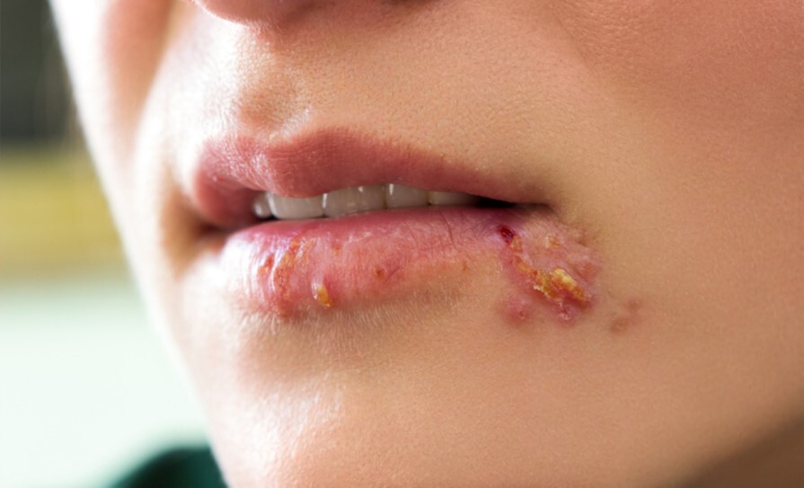 «Герпесвірусні інфекції під час вагітності» О. Луцька