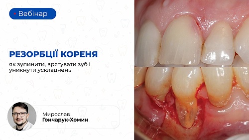 Вебінар «Резорбції кореня: як зупинити, врятувати зуб і уникнути ускладнень» (Мирослав Гончарук-Хомин)