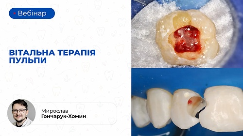 Вебінар «Вітальна терапія пульпи» (Мирослав Гончарук-Хомин)
