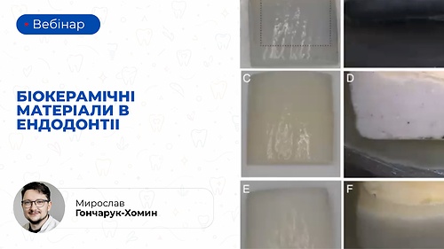 Вебінар «Біокерамічні матеріали в ендодонтіі» (Мирослав Гончарук-Хомин)