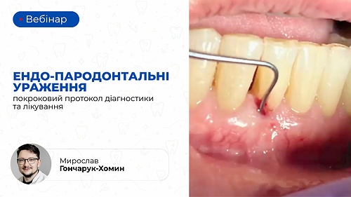 Вебінар «Ендо-пародонтальні ураження: покроковий протокол діагностики та лікування» (Мирослав Гончарук-Хомин)