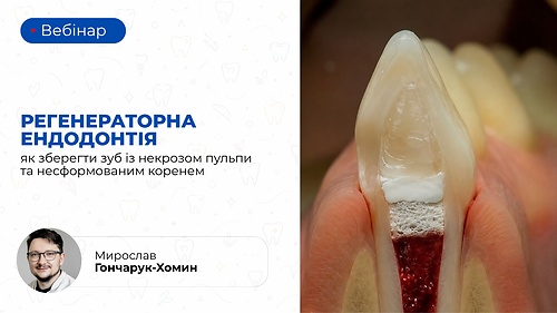 Вебінар «Регенераторна ендодонтія: як зберегти зуб із некрозом пульпи та несформованим коренем» (Мирослав Гончарук-Хомин)