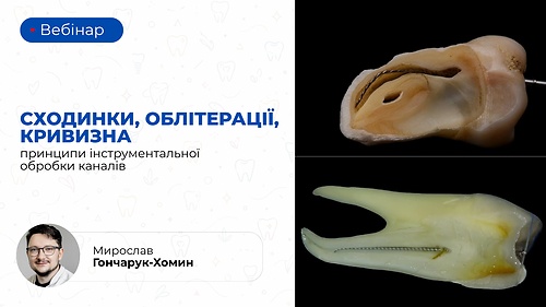 Вебінар «Сходинки, облітерації, кривизна: принципи інструментальної обробки каналів» (Мирослав Гончарук-Хомин)