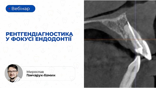 Вебінар «Рентгендіагностика у фокусі ендодонтії» (Мирослав Гончарук-Хомин)