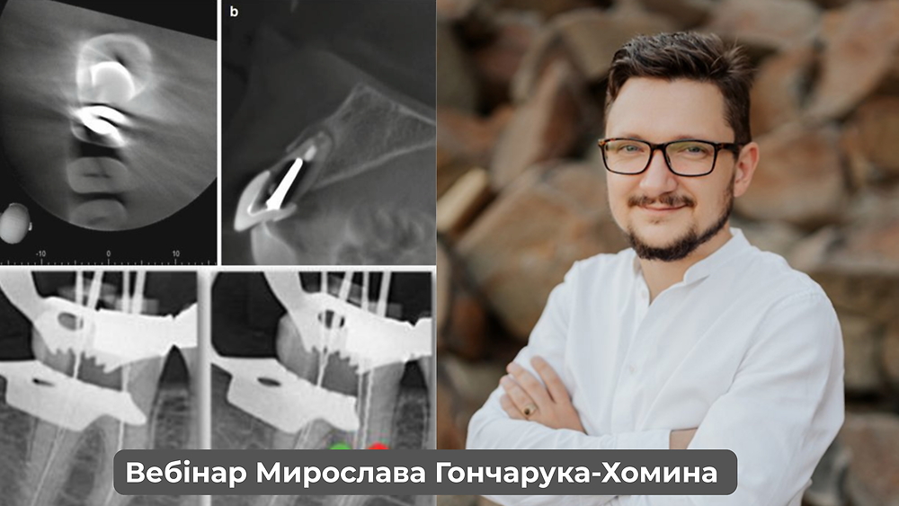 Вебінар «Ендо-пародонтальні ураження: покроковий протокол діагностики та лікування» (Мирослав Гончарук-Хомин)