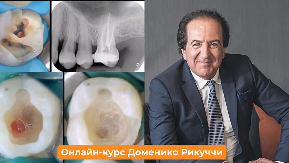 Онлайн-курс «Сохранить зуб» (Доменико Рикуччи)