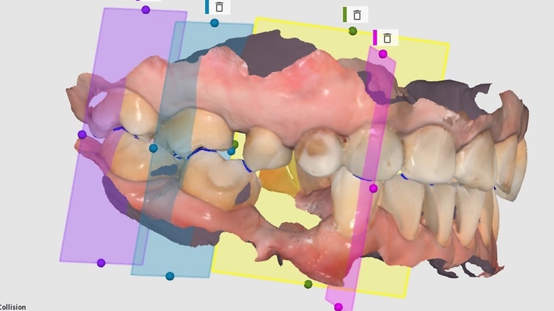 «Цифрова байт-реєстрація при інтраоральному скануванні» М. Гончарук-Хомин