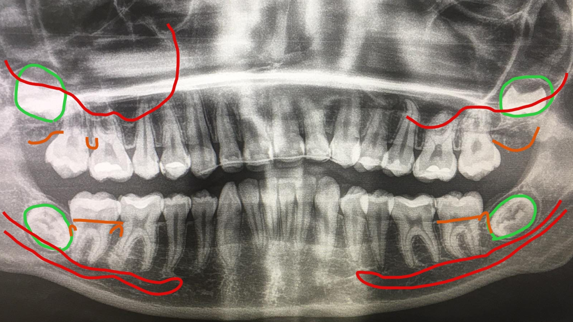 «Видалення третіх молярів 481» І. Прощин