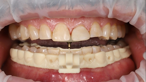 «Zebris, капи, два суглоби» Т. Глущенко