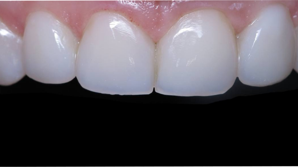 «Постендореставрація передніх зубів» К. Лазарева