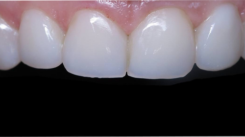 «Постендореставрація передніх зубів» К. Лазарева