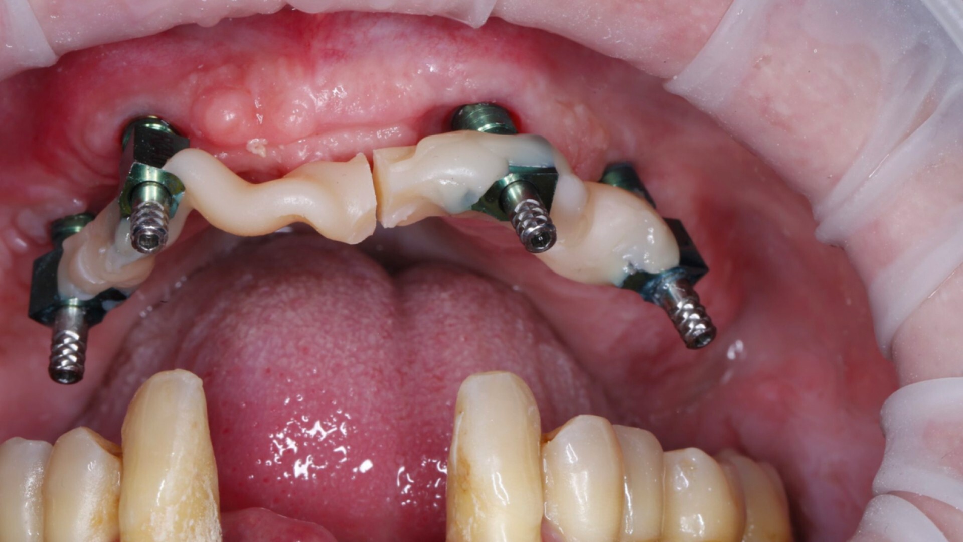 «Медикаментозне усунення ускладнень ЩЛХ» М. Жалдак