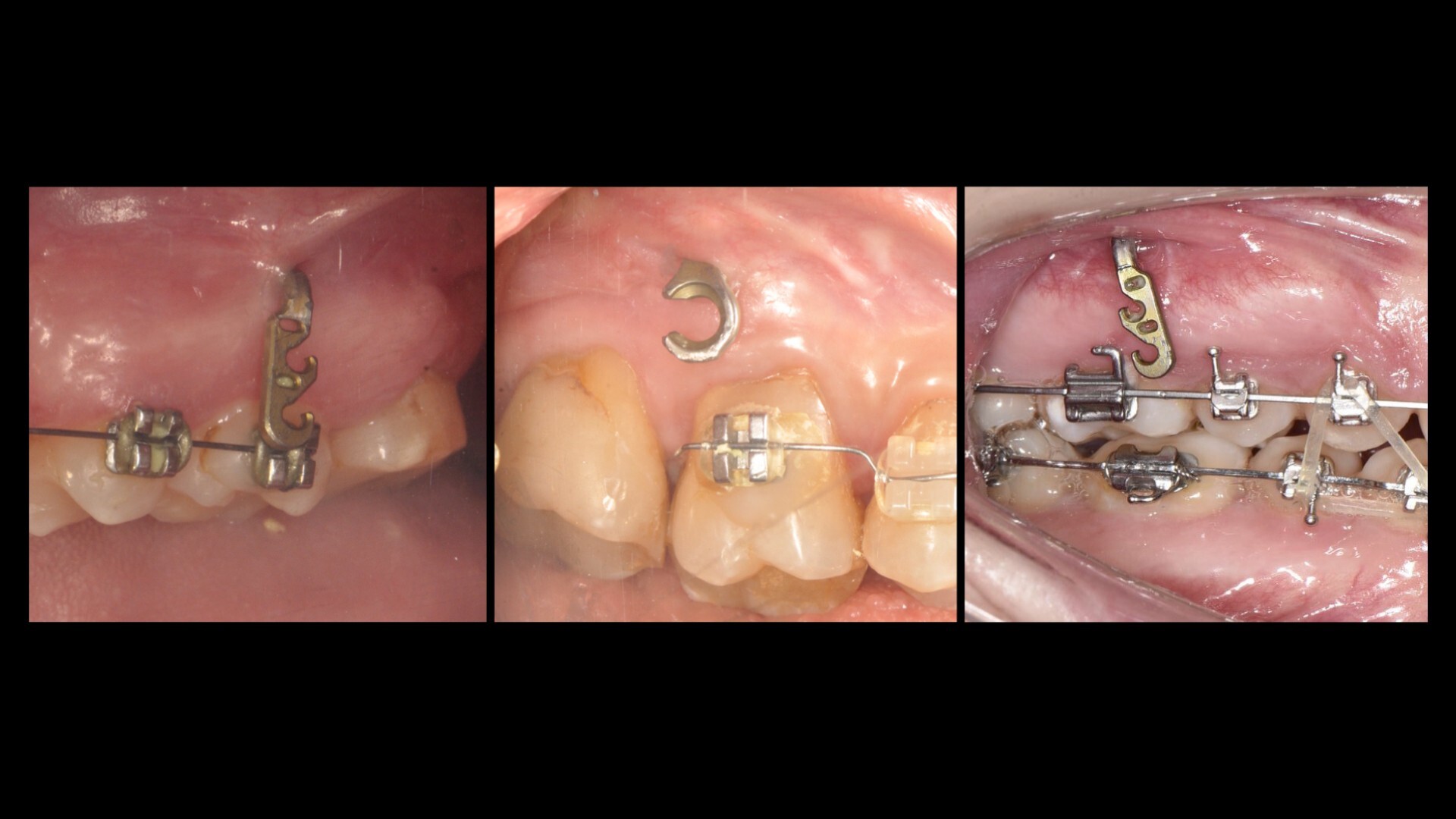 «Абсолютний кістковий анкораж» І. Прощин