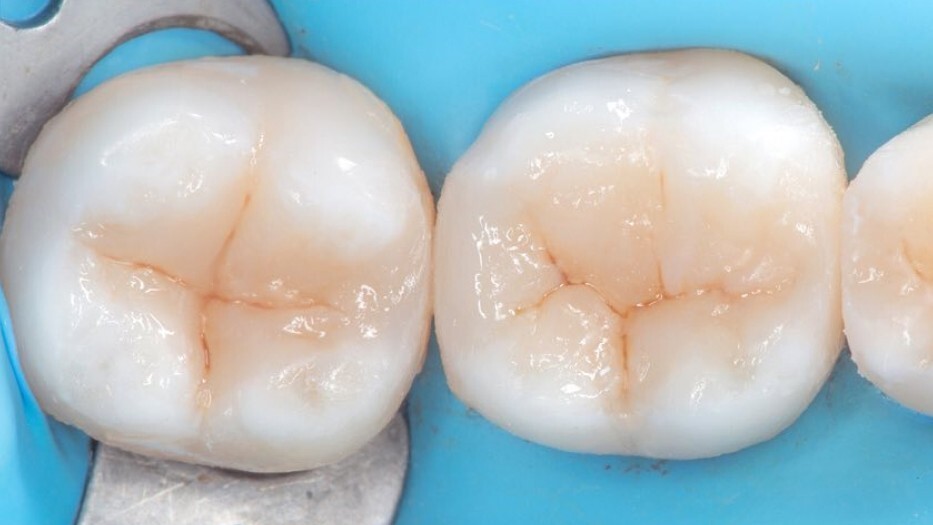 «Відновлення контактних пунктів кутніх зубів» О. Вакула