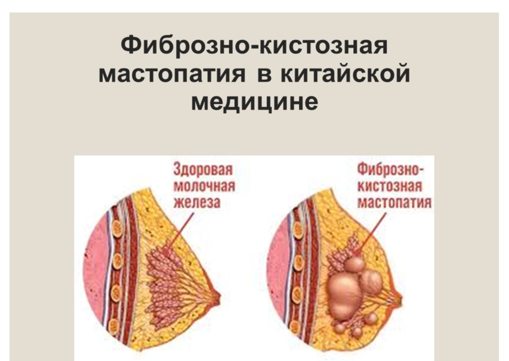 Мастопатия