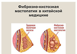 Мастопатия