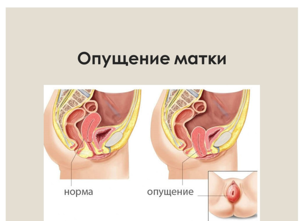 Опущение матки