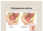 Опущение матки