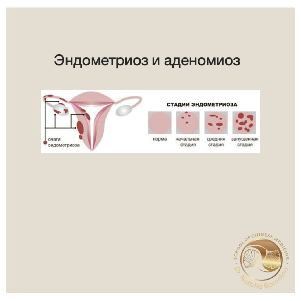 Бонусный урок- эндометриоз, лактация
